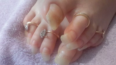 Ringstoenails